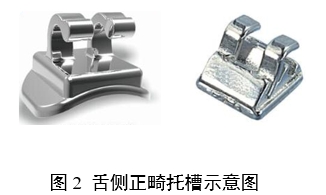 正畸托槽注冊(cè)審查指導(dǎo)原則(2022年第41號(hào))(圖2) 正畸托槽注冊(cè)審查指導(dǎo)原則(2022年第41號(hào))(圖2)