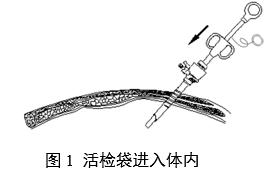 一次性使用內(nèi)窺鏡用活檢袋注冊審查指導(dǎo)原則（2025年第20號）(圖1)