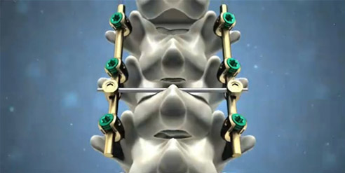 脊柱后路內(nèi)固定系統(tǒng)注冊技術審查指導原則（2016年第70號）(圖1)